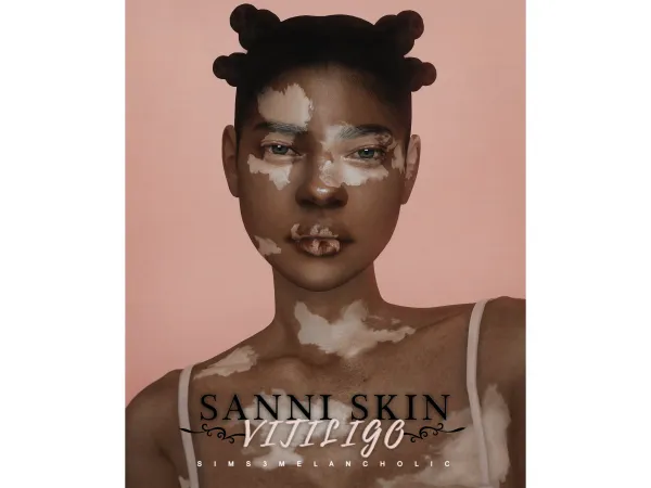 sanni sking vitiligo by sims3melancholic